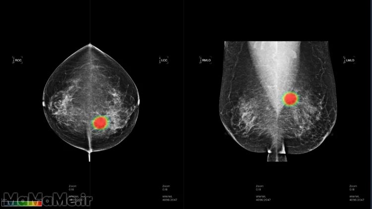 آیا-اشعه-ماموگرافی-سرطان-زا-است-؟-ماموگرافی-چیست